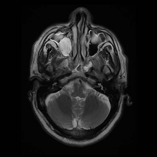 U nhầy răng (Odontogenic myxomas)