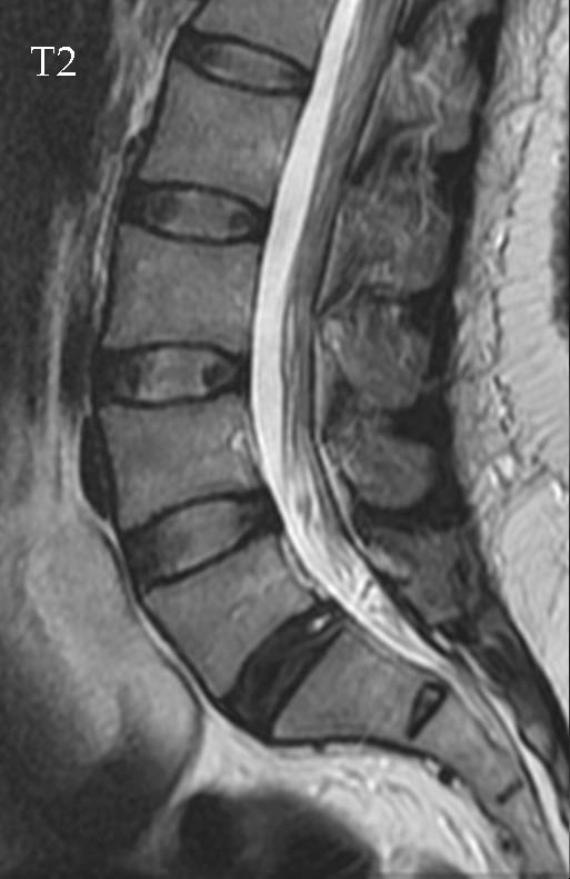 Mất nước đĩa đệm (Disc dehydration)