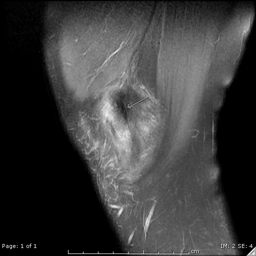 Tổn thương dây chằng bên trong (Medial Collateral Ligament - MCL injuries)
