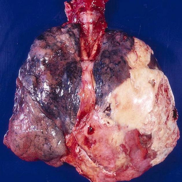 Tràn mủ màng phổi (Empyema)