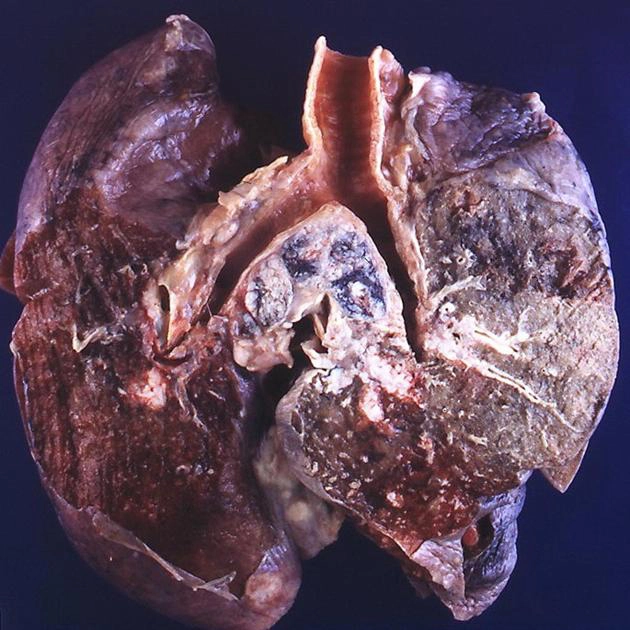 Ung thư phổi tế bào nhỏ (Small cell lung carcinoma - SCLC)