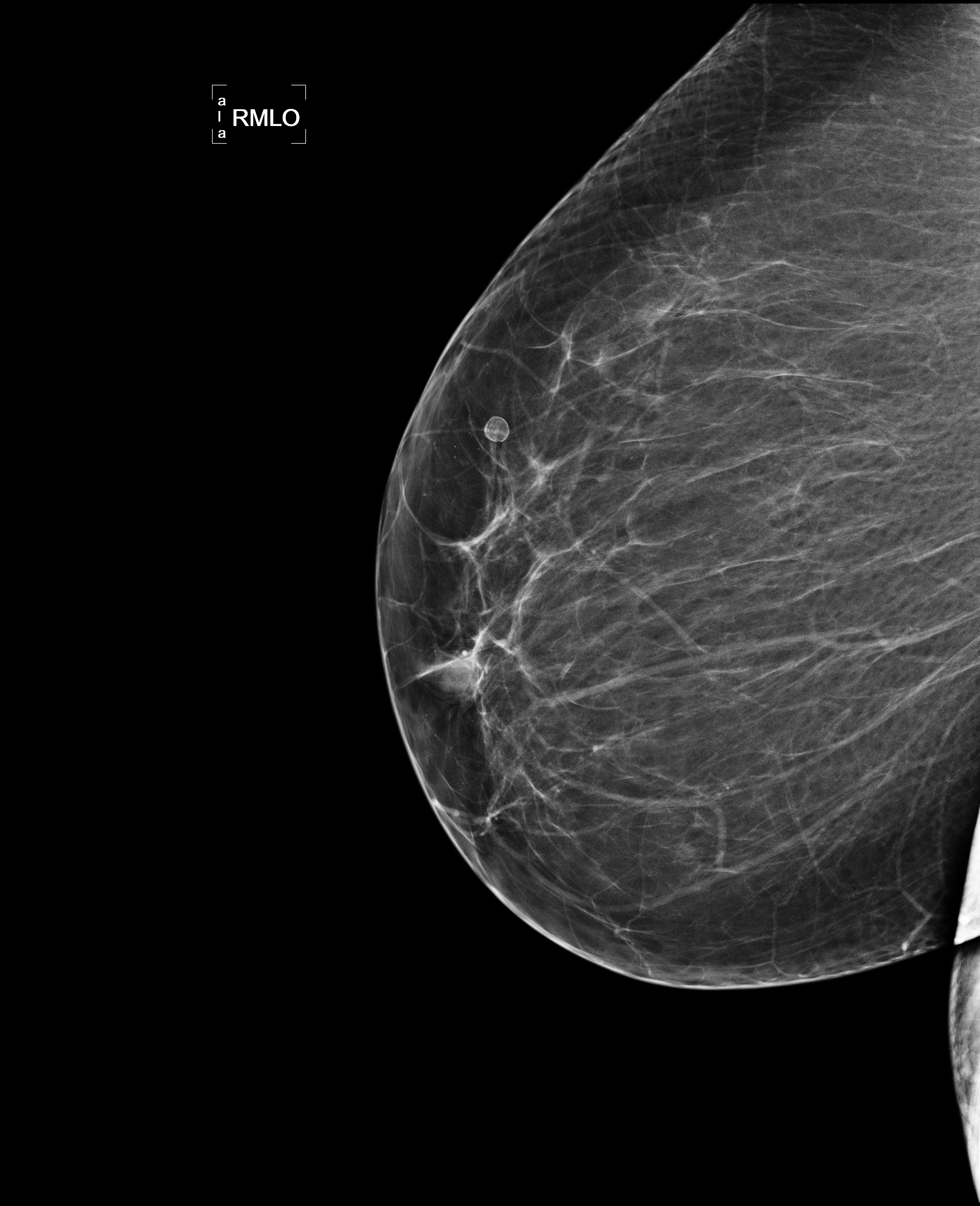 Nang dầu tuyến vú (Oil cyst (breast))