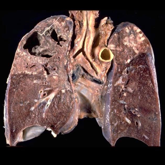 Lao phổi (Tuberculosis - Pulmonary Manifestations)