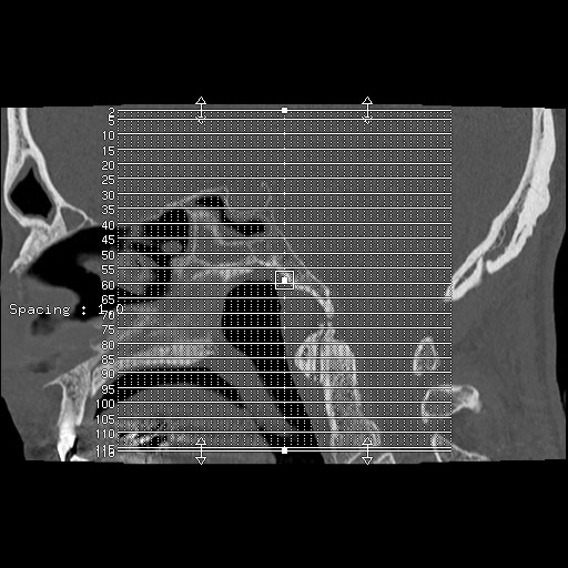 Lỗ nhĩ (Foramen tympanicum)
