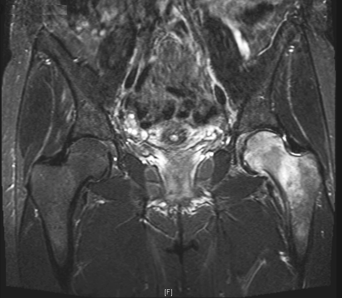 Loãng xương thoáng qua khớp háng (Transient osteoporosis of the hip)