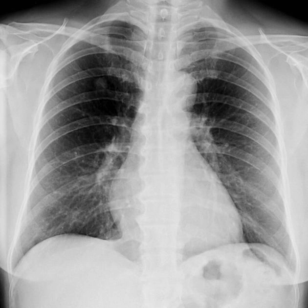 U carcinoid phổi ngoại biên (Peripheral Pulmonary Carcinoid Tumor)