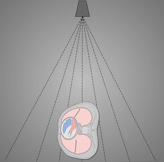 X-quang ngực tư thế nghiêng (Chest - lateral view) 