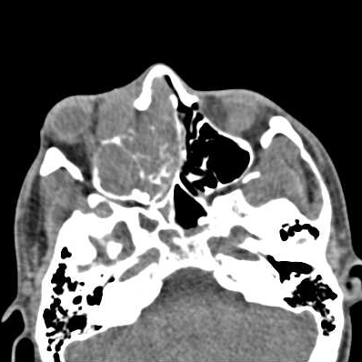 Ung thư biểu mô không biệt hóa mũi xoang (Sinonasal undifferentiated carcinomas - SNUC)