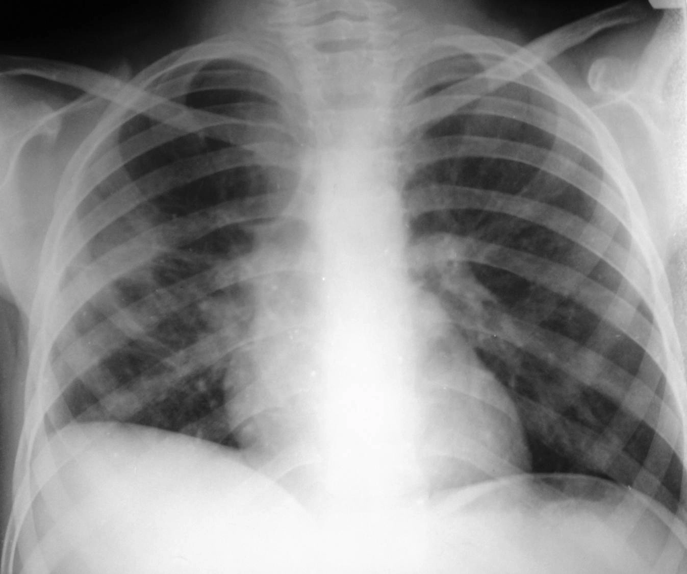 Tràn dịch dưới phổi (Subpulmonic Effusion)