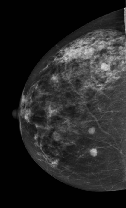 Di căn đến vú (Metastases to the breast)