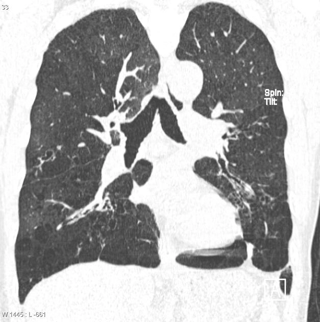 Tổn thương dạng khảm (Mosaic attenuation)