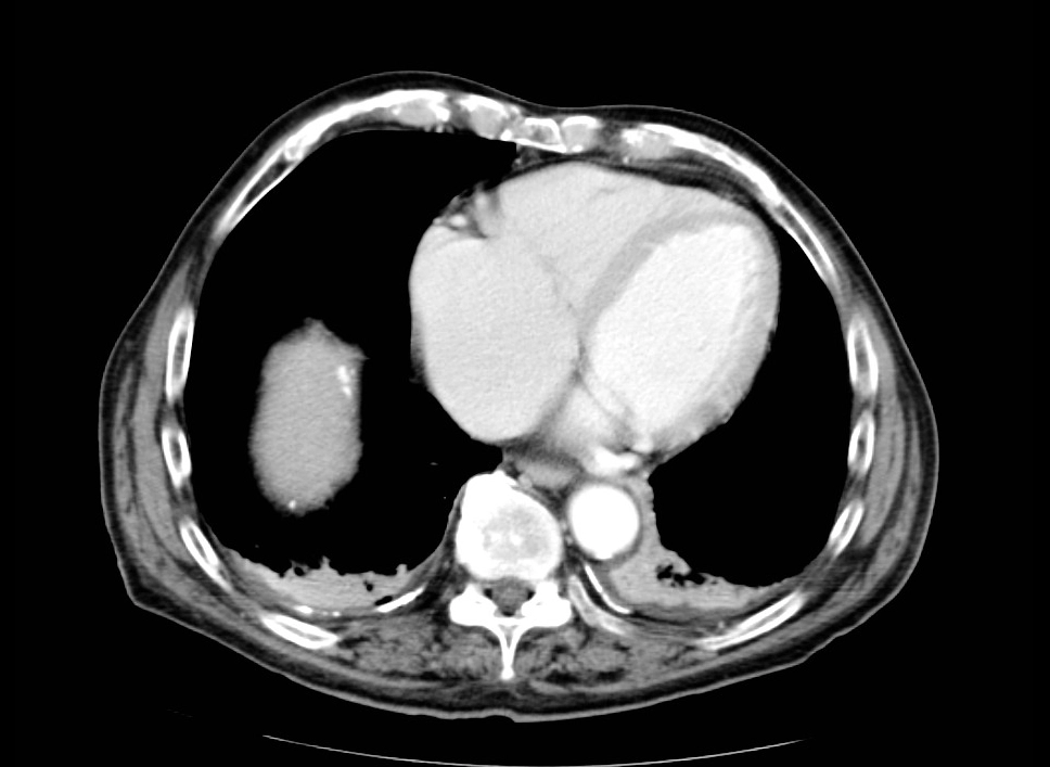 Thiếu máu mạc treo do tắc động mạch (Arterial occlusive mesenteric ischemia)