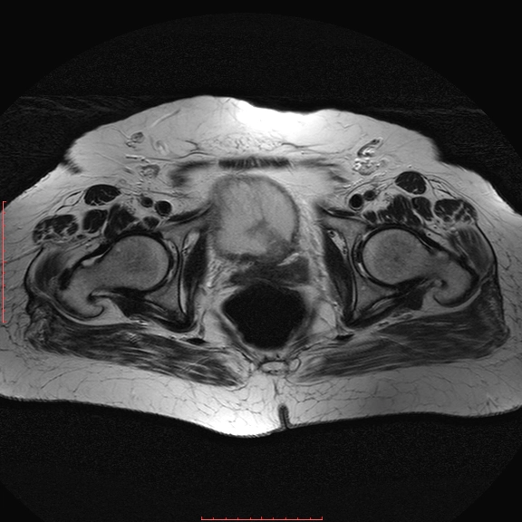 Ung thư niệu đạo nguyên phát (Primary urethral cancer)