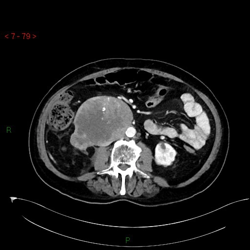 Sarcoma cơ trơn sau phúc mạc (Retroperitoneal leiomyosarcoma)