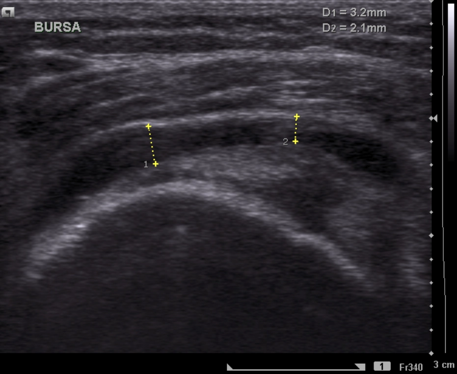 Viêm bao hoạt dịch dưới mỏm cùng vai (Subacromial-subdeltoid bursitis)