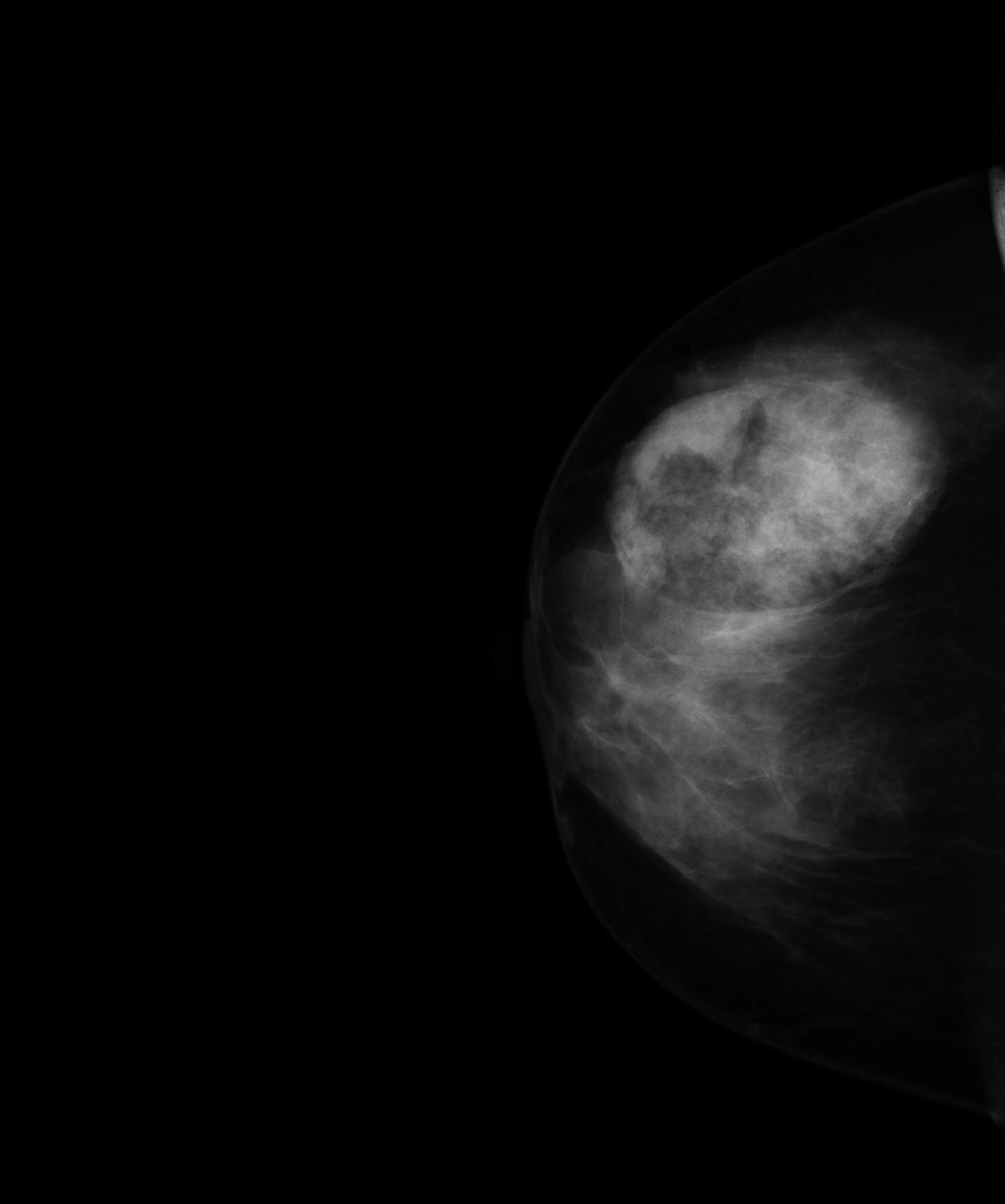 U mô thừa tuyến vú (Breast hamartomas) (hình ảnh vú trong vú)