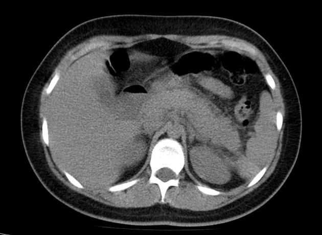 Ổ tụ dịch cấp tính quanh tụy (Acute Peripancreatic Fluid Collection - APFC)