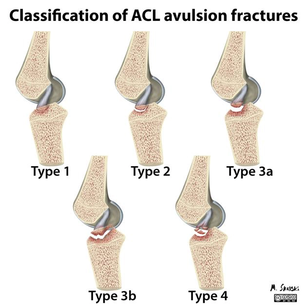 Gãy bong điểm bám dây chằng chéo trước (Anterior cruciate ligament avulsion fracture- ACL)
