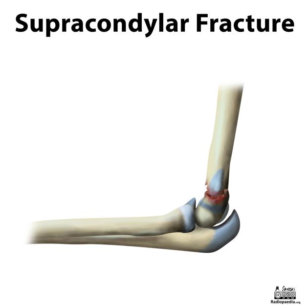 Gãy trên lồi cầu xương cánh tay (Supracondylar Humeral Fracture)