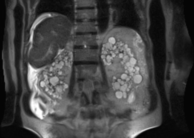 Bệnh thận đa nang mắc phải (Acquired Cystic Kidney Disease - ACKD)