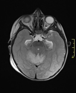 Thoát vị lều tiểu não hướng lên (Ascending Transtentorial Herniation)