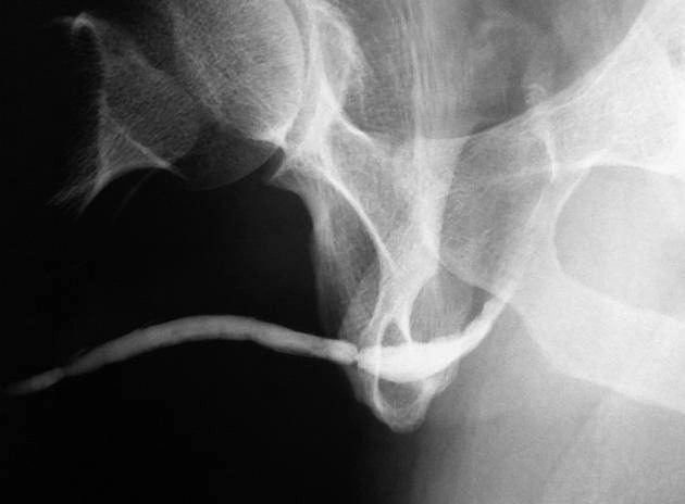 Hẹp niệu đạo (Urethral stricture)