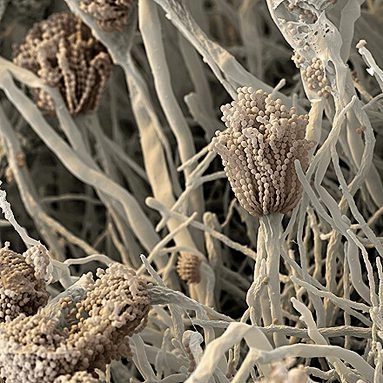 Viêm phế quản phổi dị ứng do nhiễm nấm Aspergillus (Allergic bronchopulmonary aspergillosis - ABPA)