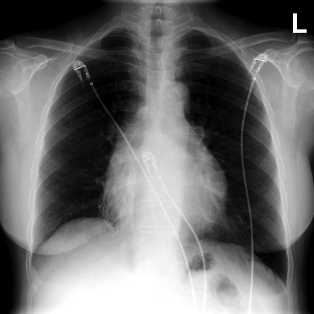 Dấu hiệu bánh Oreo (tim) - Oreo cookie sign (heart)/Dấu hiệu đệm mỡ màng ngoài tim (Fat Pad Sign)
