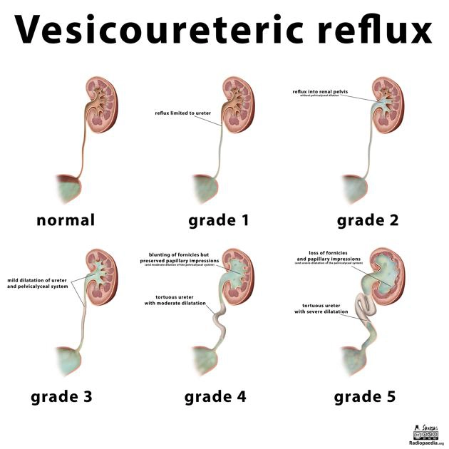 Trào ngược bàng quang-niệu quản (Vesicoureteric Reflux - VUR)