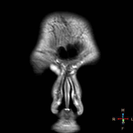 Nang bì ổ mắt (Orbital dermoid cysts)