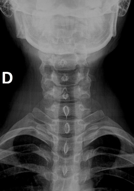 Gãy bong mỏm gai (Gãy Clay-Shoveler)