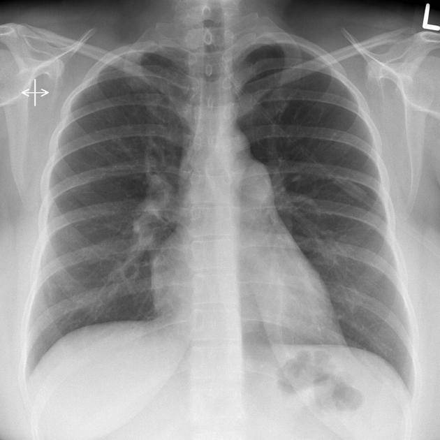Tăng áp động mạch phổi (Pulmonary artery hypertension - PAH)