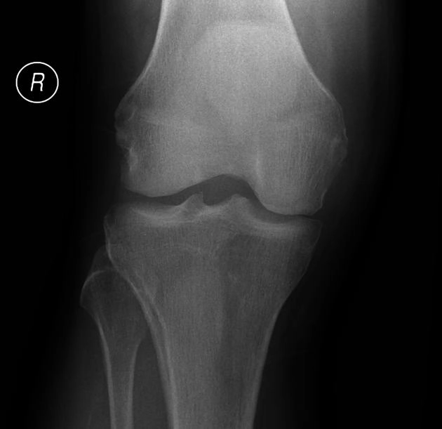 Gãy xương dưới sụn do mỏi ở gối (Subchondral insufficiency fracture of the knee - SIFK) 
