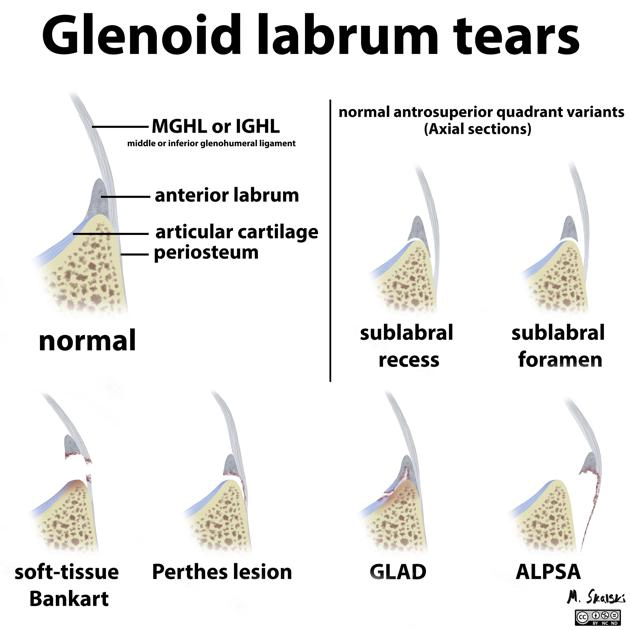 Lỗ dưới sụn viền (Sublabral foramen- SLF) 