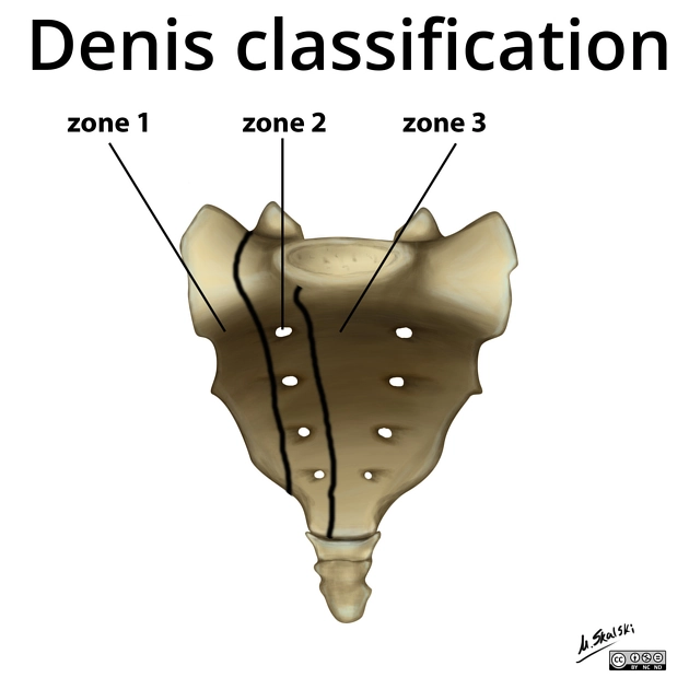 Gãy xương cùng (Sacral fractures)