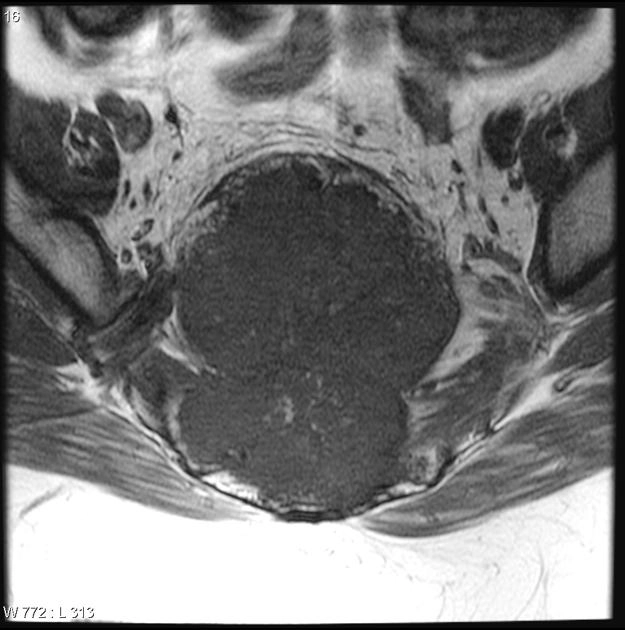 U máu ở xương (Primary intraosseous hemangioma)