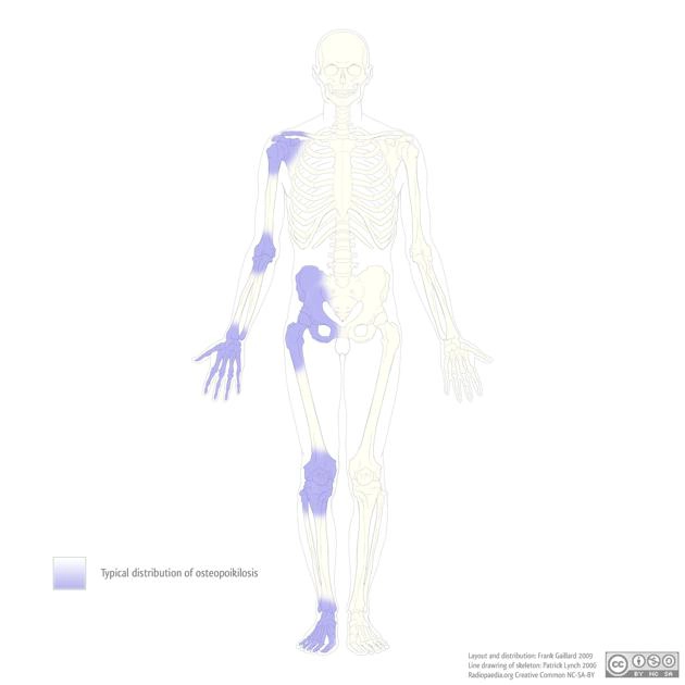 Bệnh xương đặc đốm (Osteopoikilosis)