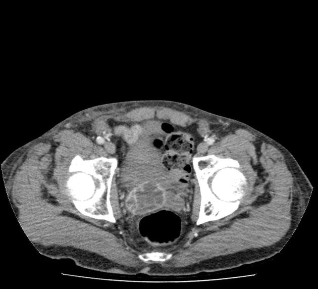 Viêm túi tinh (Seminal vesiculitis)