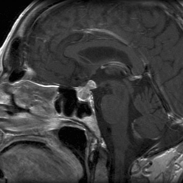 Di căn tuyến yên (Pituitary Metastases)