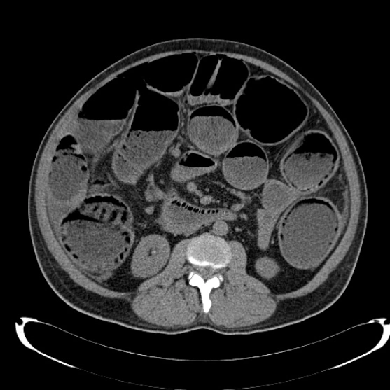 Thủng đại tràng (Large bowel perforation)