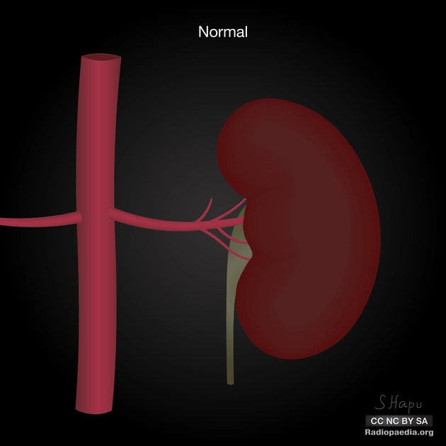 Động mạch thận phụ (Multiple renal arteries)