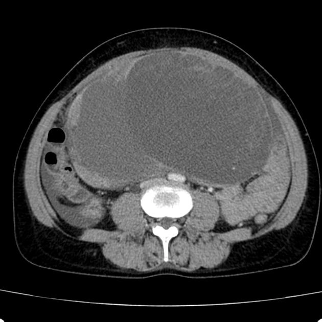 Ung thư nang tuyến dịch nhầy buồng trứng (Ovarian mucinous cystadenocarcinoma)