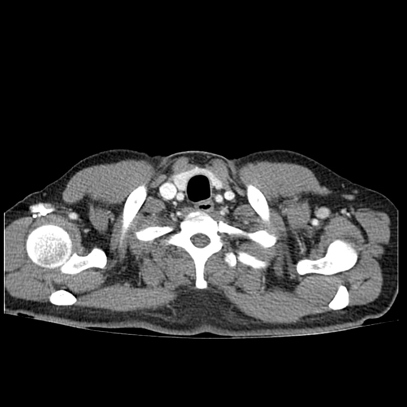 Polyp đại tràng (Colon polyps)
