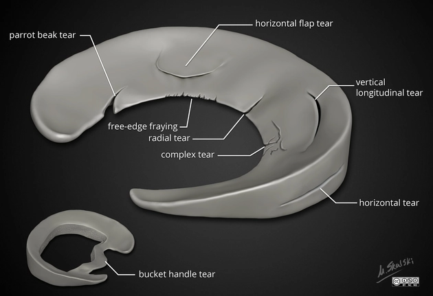 Rách dọc sụn chêm (Vertical meniscal tear)