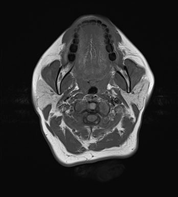 Khí hóa bất đối xứng đỉnh xương đá (Asymmetric pneumatization of the petrous apex)