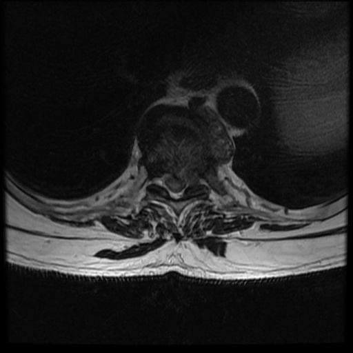 U di căn đốt sống (Vertebral metastases)
