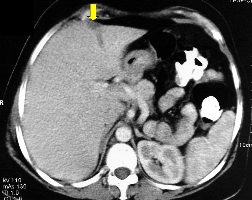 Giả tổn thương gan cạnh dây chằng liềm (Hepatic pseudolesions near the falciform ligament)