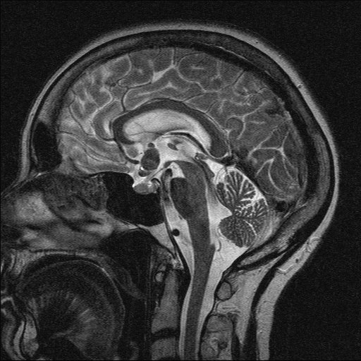 U thần kinh đệm dạng dây của não thất 3 (Chordoid Glioma of the 3rd Ventricle - CGOTV)