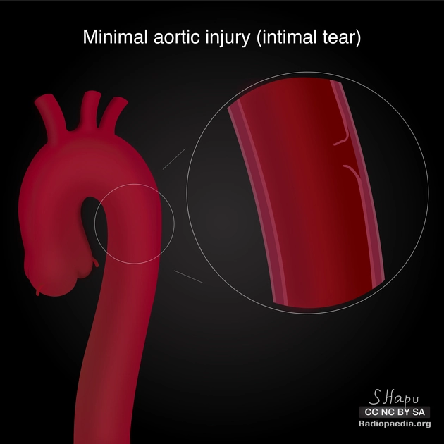 Tổn thương động mạch chủ do chấn thương (Traumatic Aortic Injury - TAI)