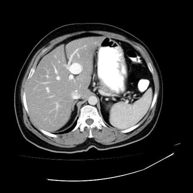 Giãn tĩnh mạch cửa (Portal venous varix)